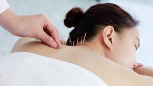 The Health Benefits of Accupuncture: A Guide